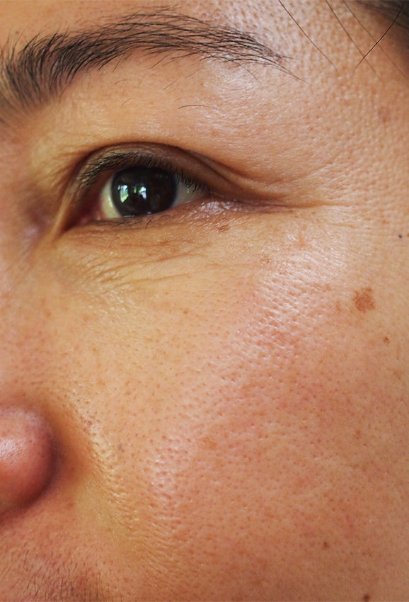 Fine Lines & Early Aging